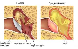 Хронический отит у взрослых и детей