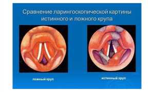 Ложный круп