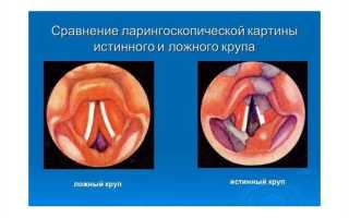 Ложный круп