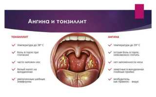 Гнойная ангина у взрослых: симптомы и лечение