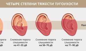 Сенсоневральная тугоухость — симптомы и лечение