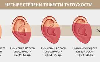 Сенсоневральная тугоухость — симптомы и лечение