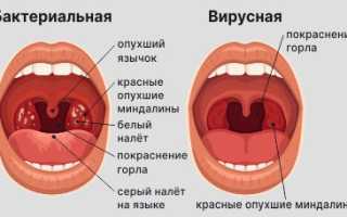Гнойная ангина у детей: как выявить и чем лечить