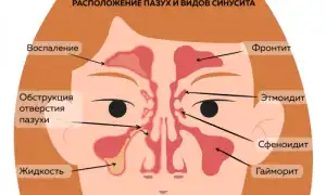 Катаральный гайморит: симптомы и лечение