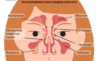 Катаральный гайморит: симптомы и лечение
