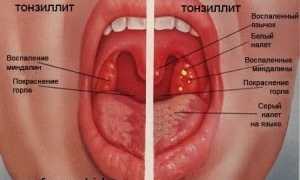 Лечение ангины у ребенка в домашних условиях