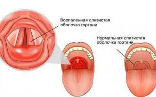 Аллергический ларингит у детей и взрослых