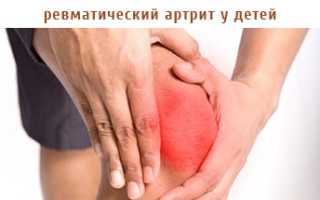 Ревматический артрит у ребенка – причины, симптомы, диагностика и лечение