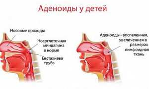 Что такое острый аденоидит и как он развивается у детей и взрослых