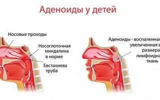 Что такое острый аденоидит и как он развивается у детей и взрослых