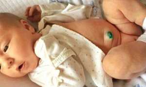 Пупочная грыжа у новорожденного: фото, как определить, лечение в домашних условиях, отзывы (с форумов)