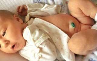 Пупочная грыжа у новорожденного: фото, как определить, лечение в домашних условиях, отзывы (с форумов)