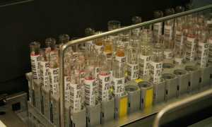 Глюкоза в моче при беременности: причины и последствия, нормы, отзывы