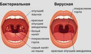 Вирусная ангина — симптомы и лечение у детей и взрослых