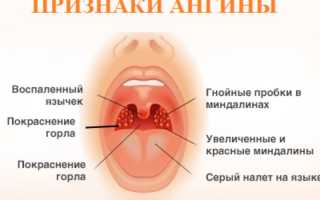 Ангина: симптомы и лечение