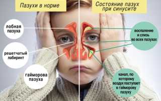Синусит у детей