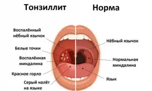 Тонзиллофарингит — особенности развития, клиническая картина и методы лечения