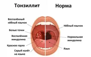 Тонзиллофарингит — особенности развития, клиническая картина и методы лечения