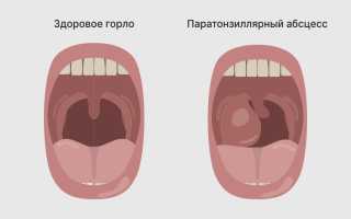 Абсцесс гортани — гнойное воспаление лимфоидной ткани и осложнение после инфекционных заболеваний