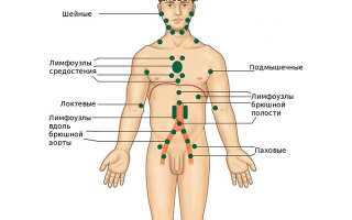 Что такое паховый лимфаденит у мужчин, его симптомы и факторы риска