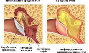 Симптомы и лечение болезней среднего уха