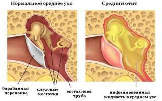 Симптомы и лечение болезней среднего уха