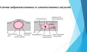 Интоксикация при доброкачественной опухоли