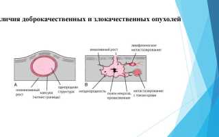 Интоксикация при доброкачественной опухоли
