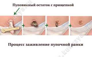 Пупок у новорожденного: алгоритм обработки, с прищепкой
