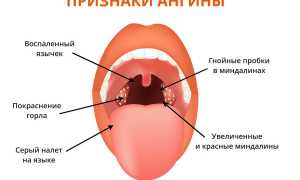 Ангина Симановского-Плаута-Венсана — опасное инфекционное заболевание