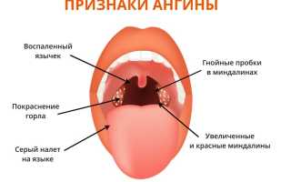 Ангина Симановского-Плаута-Венсана — опасное инфекционное заболевание