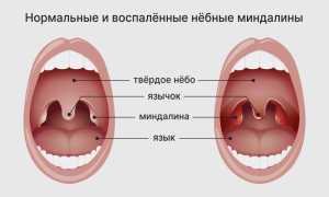 Ангина во втором триместре беременности