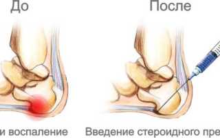 Блокада пяточной шпоры: показания, особенности проведения
