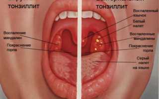 Некротическая ангина — симптомы, лечение, прогноз