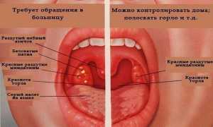 Лечение ангины в домашних условиях у взрослых и детей