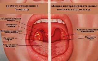 Лечение ангины в домашних условиях у взрослых и детей