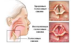 Хронический ларингит у взрослых