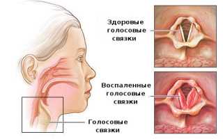 Хронический ларингит у взрослых