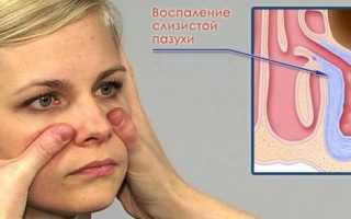 Синусит у беременных