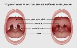 Ангина при беременности, как и чем лечить?