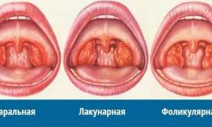 Бывает ли ангина без температуры и есть ли разница в лечении?