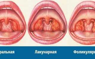 Бывает ли ангина без температуры и есть ли разница в лечении?