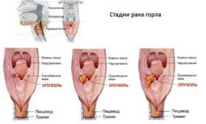 Стадии рака горла — 1, 2, 3 и 4 стадия развития — симптомы и прогноз
