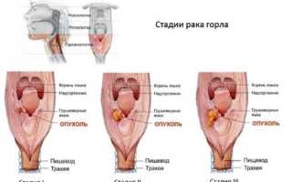 Стадии рака горла — 1, 2, 3 и 4 стадия развития — симптомы и прогноз