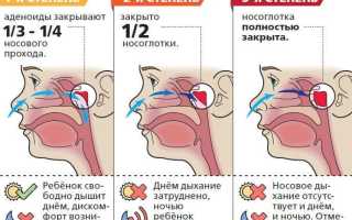 Что такое гнойный аденоидит и как он развивается?