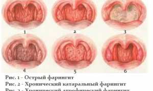 Фарингит — причины, симптомы и лечение