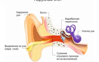 Лечим отит в домашних условиях: народные средства при отите