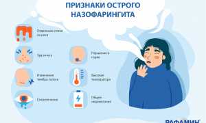Что такое назофарингит, особенности развития, симптомы и лечение у детей и взрослых