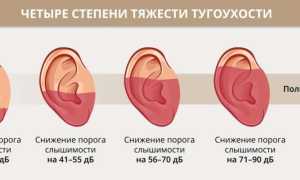 Нейросенсорная тугоухость 1, 2, 3 и 4 степени — симптомы и лечение