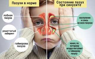 Риносинусит — симптомы и лечение